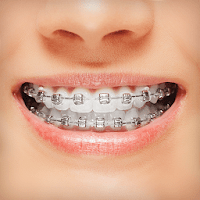 Брекеты — Braces для Android
